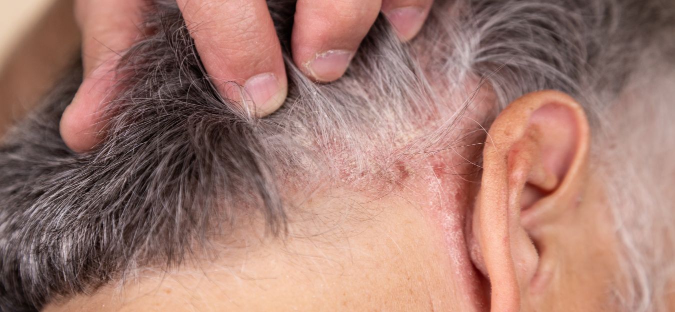 causes of skin cancer on scalp