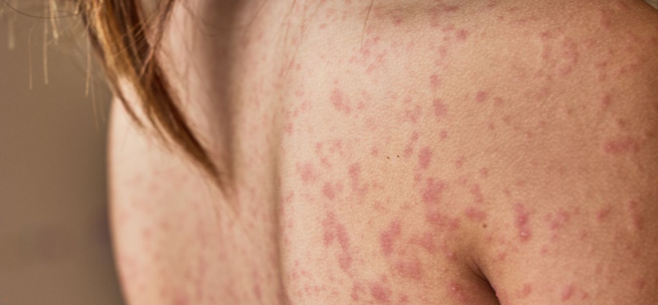 A woman's back, covered in a skin rash.